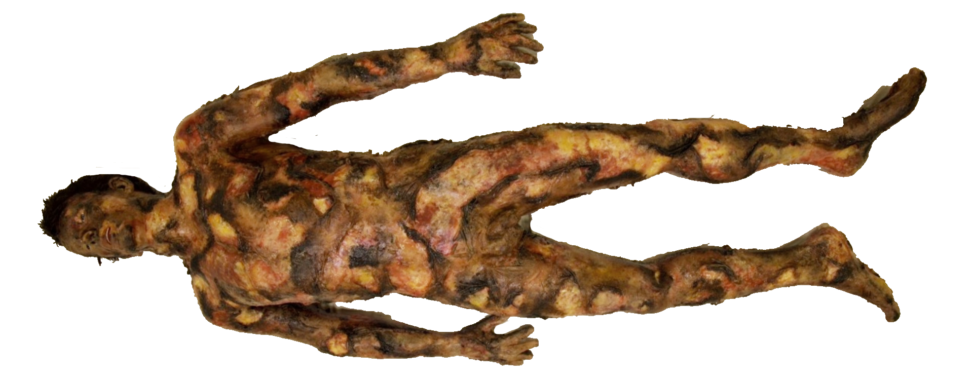 SimBodies Lifeless Burnt Manikin