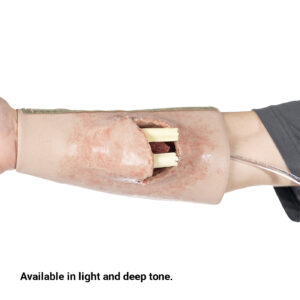 SMRT Trainer, Forearm Fracture