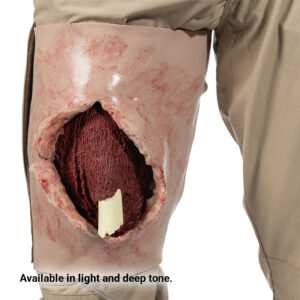 SMRT Trainer, Femur Fracture