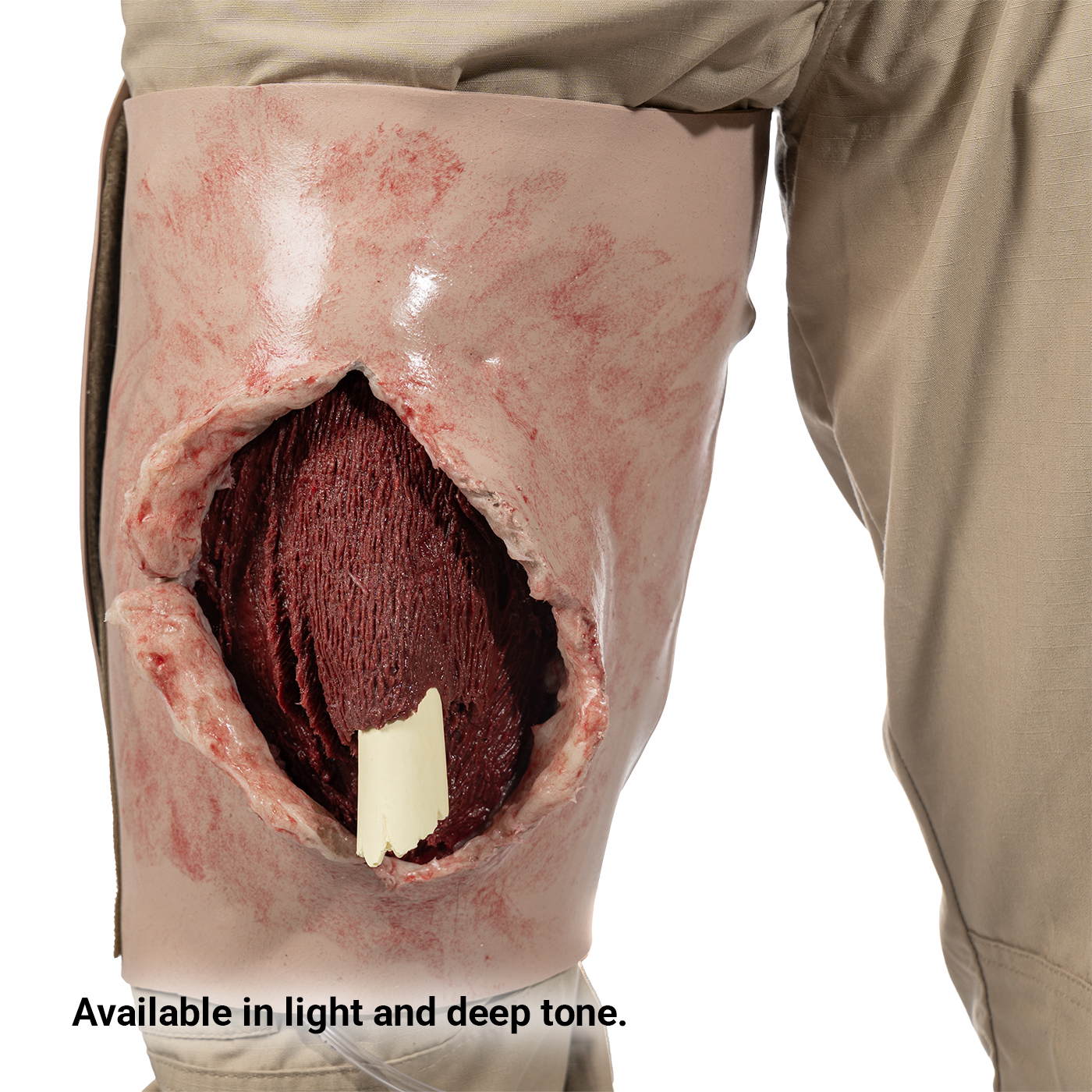 SMRT Trainer, Femur Fracture
