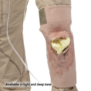 SMRT Trainer, Tibia Head Fracture