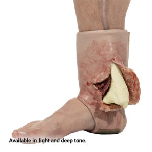 SMRT Trainer, Ankle Fracture